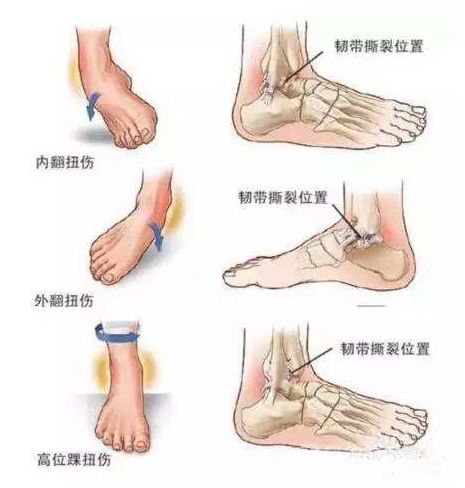 崴脚韧带撕裂需要多长时间恢复,崴脚了怎么护理饮食