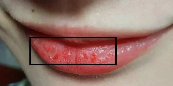 起皮唇部专用润唇膏,润唇膏唇干裂专用