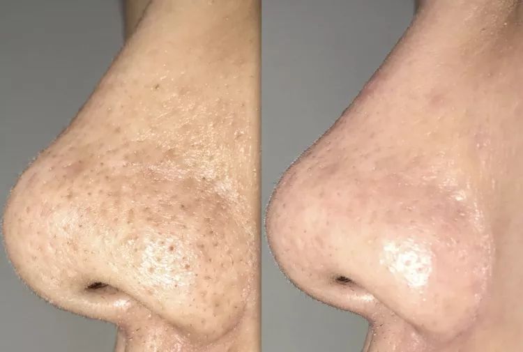 辣眼睛，有人用它吸出一整年的黑头，看完我果断下单了！