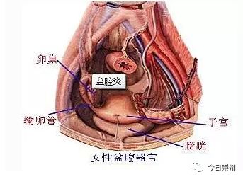 「崇州妇幼」女性下腹坠痛,多数都是它惹祸