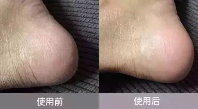 手足脱皮脚后跟干裂修复膏,奇迹第十代