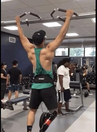 俄罗斯留学生骨折截肢,留学生意外被截肢