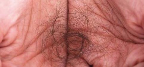 头上头皮屑和剪发虫怎么解决,头皮屑多且大块还结痂会不会有虫