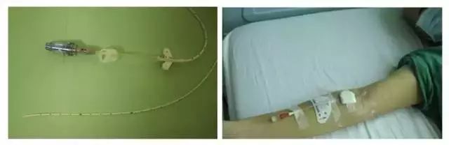 picc静脉置管维护挂哪个科好,picc置管后有什么注意事项