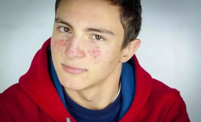 药师讲痘痘视频,药师说痘痘