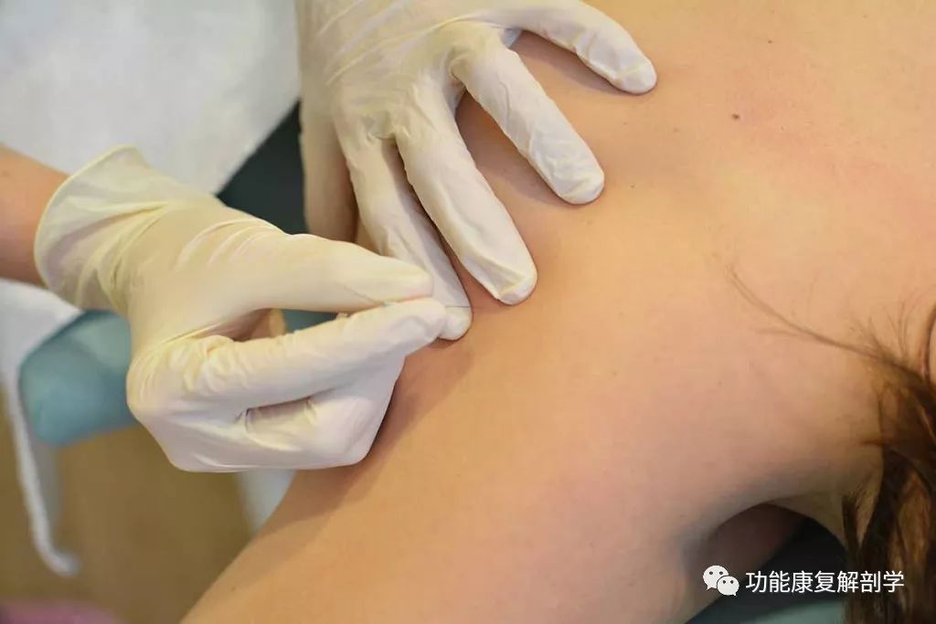 冈上肌肌腱炎超声波治疗,冈上肌腱炎怎么用药