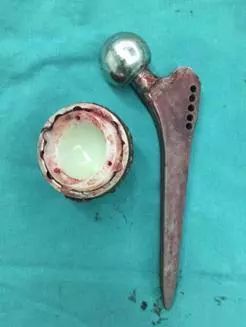 「筋骨堂」人工髋关节并非一劳永逸