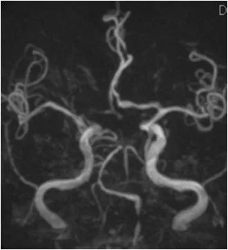 椎动脉v4段血管瘤介入治疗,臭氧治疗左侧v4段椎动脉狭窄