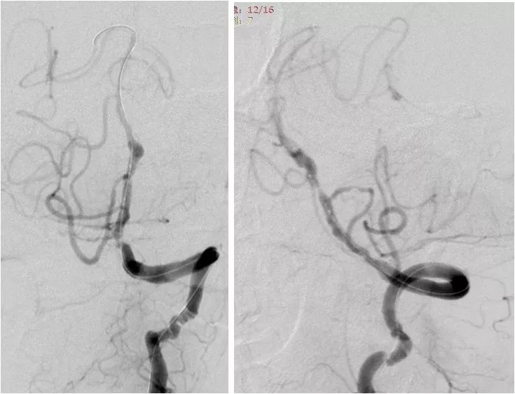 椎动脉v4段血管瘤介入治疗,臭氧治疗左侧v4段椎动脉狭窄