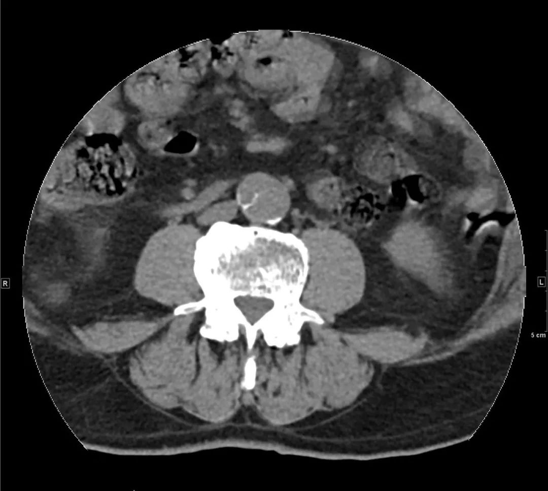 心冠动脉夹层能治愈吗,夹层动脉血管破裂症状
