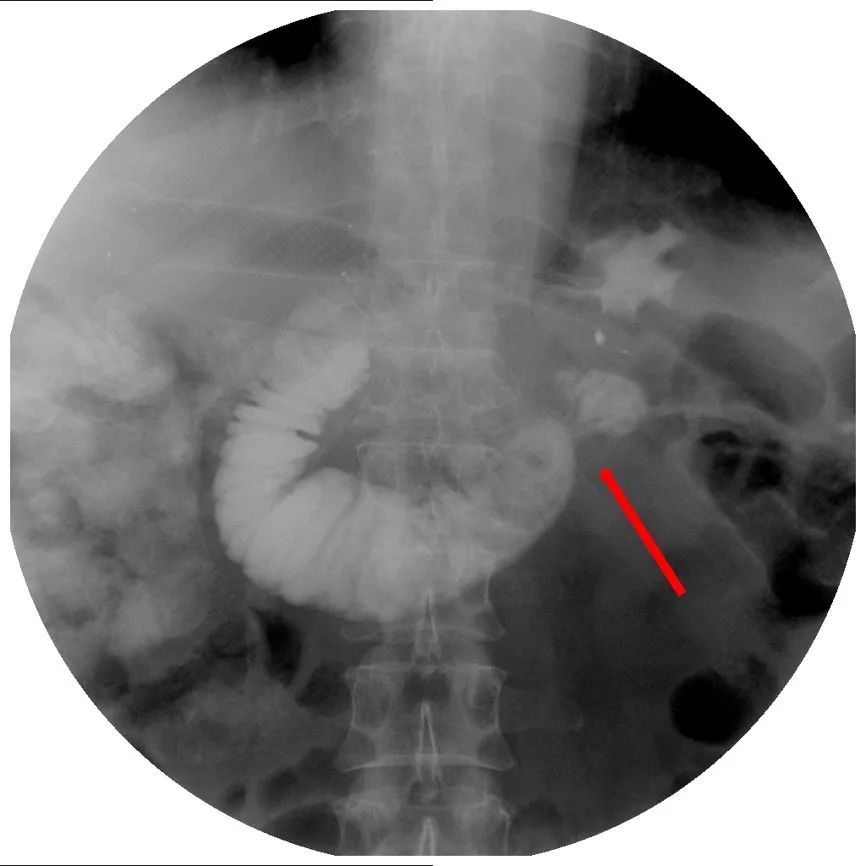 消化道支架置入术,消化道梗阻支架怎么放