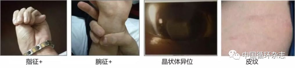 北京哪家医院诊断马凡综合征,广州哪个医院检测马凡综合征