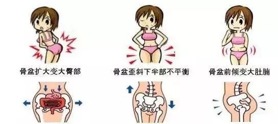 女人骨盆移位怎么造成的,女性骨盆倾斜的纠正手法