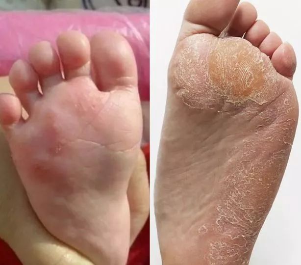 脚臭怎么办教你除臭小妙招,脚痒脚臭怎么办教你除臭方法