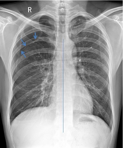 气胸的x线表现胸膜炎,胸外科气胸病人病例