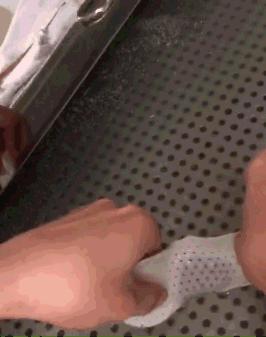 刚出生就要打石膏？硬核医生手工打造矫形器治疗足外翻