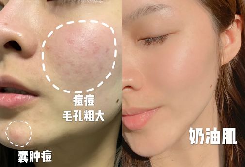 祛斑美白补水祛皱祛痘,祛斑祛痘美白改善暗沉