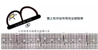 常见心律失常的识别和处理,心衰合并恶性心律失常的治疗策略