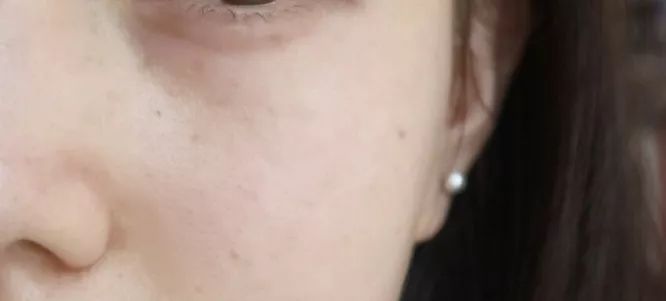 严重痘印晒斑,5个祛斑小妙招淡化晒斑雀斑痘印