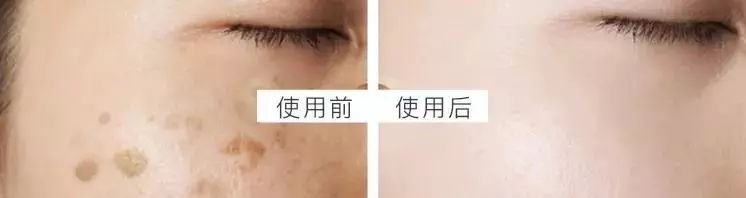晒斑痘印去除土方法,5个祛斑小妙招淡化晒斑雀斑痘印
