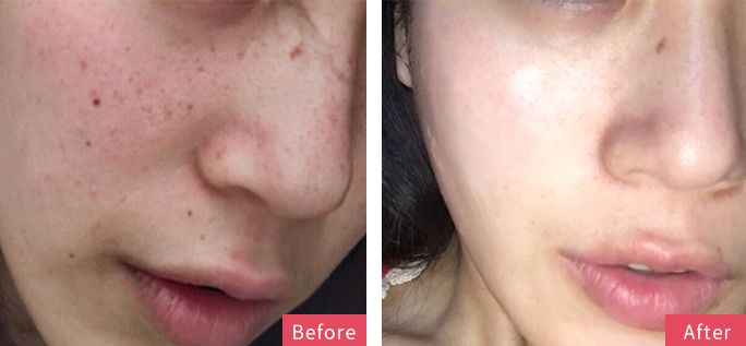 5个祛斑小妙招淡化晒斑雀斑痘印,晒斑痘印怎么消除的最快方法