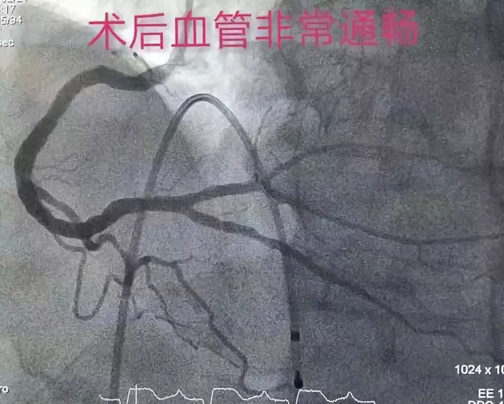 急性心肌梗死院前急救的急救措施,中医治疗急性心肌梗死的急救方法