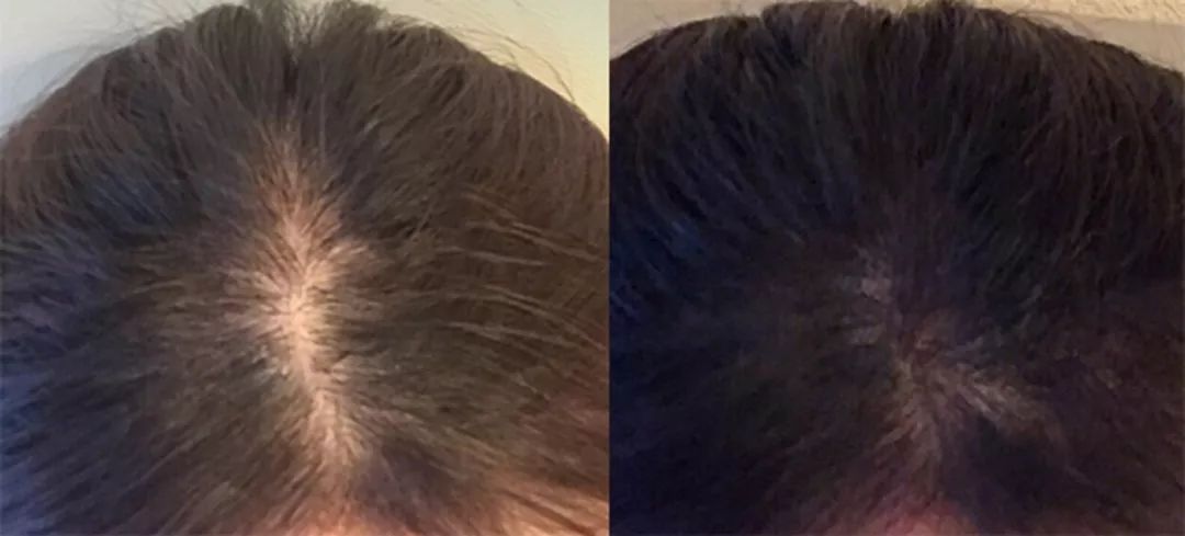 发际线防脱发神器,增发神器发际线