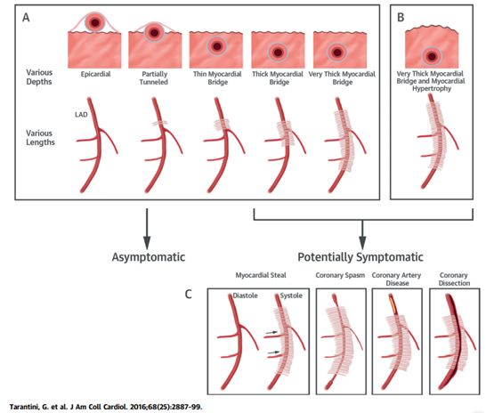 心脏有心肌桥是怎么回事啊,心脏有压榨感是心肌桥的事吗