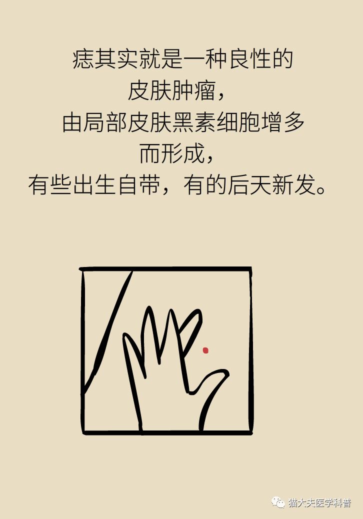 什么症状表明痣已经在恶变,先天性黑素细胞痣恶变的概率大吗