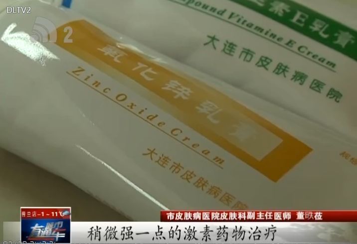 湿疹天然药,脸上湿疹涂了有激素的药膏怎么办