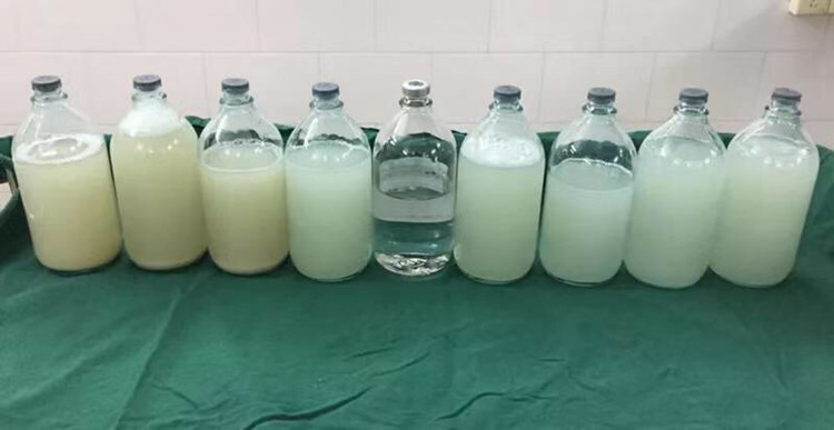 肺部洗出17升牛奶,毛骨悚然男子肺部竟洗出17升牛奶