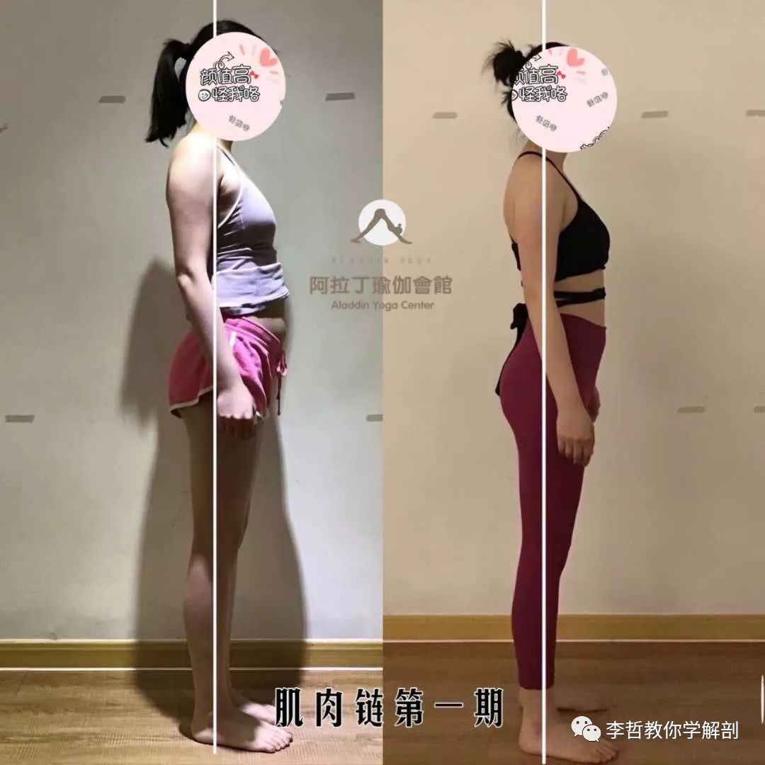 腰间盘突出脊柱侧弯康复训练,螺旋肌肉链训练治疗腰椎间盘突出