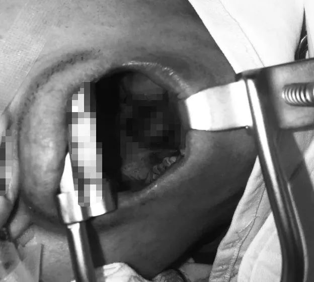 小伙咳嗽有痰怎么回事,一小伙咳嗽咳出肺部组织