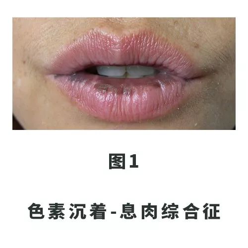 口唇黑斑,口唇上的黑印