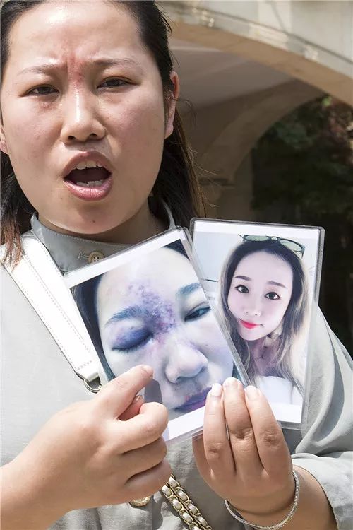 女子鼻部注射玻尿酸导致失明,打玻尿酸隆鼻子失败案