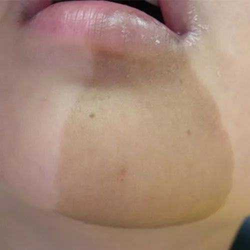 孩子为什么长咖啡斑,怀孕期间喝咖啡会不会长斑