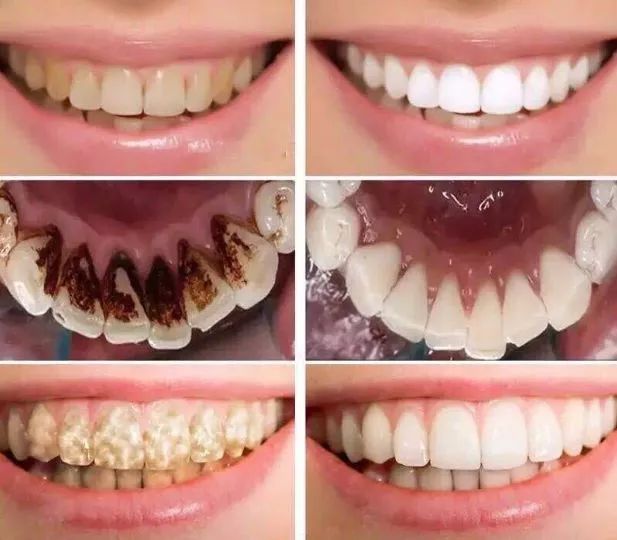 最好的口腔神器,好的去牙黄神器推荐