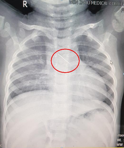 惊险！温州一婴儿连续几天吐血竟是误食了一根针！