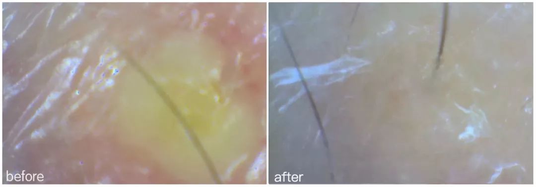 灏忚寕鑲岃瘖瀹よˉ姘村悧,灏忚寕鑲岃瘖瀹ゅ埌搴曟湁澶氬己