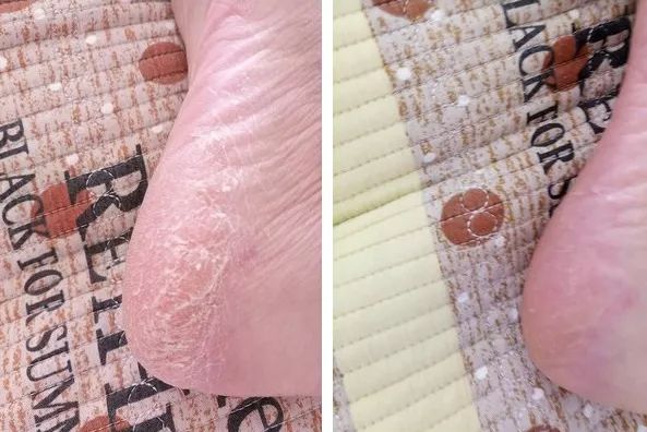 足部护理加长加热脚套,足部护理脚趾套品牌