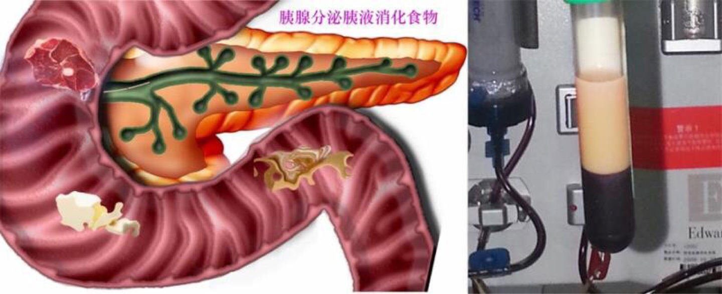 体重340斤,血脂高到仪器爆表!压塌CT机,瑞金医护团队成功救治重症急性胰腺炎患者