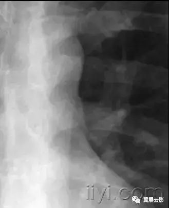 胸部解剖及常见疾病影像表现,胸部影像学基础知识