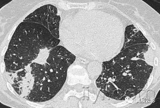 胸部解剖及常见疾病影像表现,胸部影像学基础知识