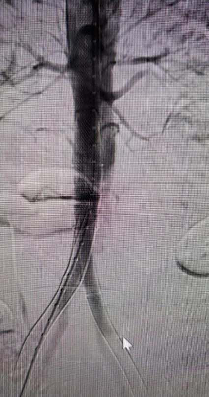 华西主动脉夹层手术怎样,再次救治急性主动脉夹层取得成功