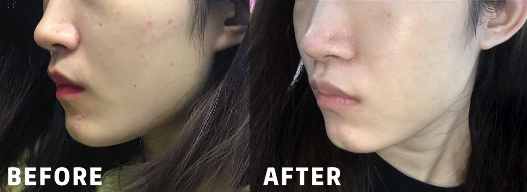 水光针副作用这么可怕,水光针有什么医疗隐患吗