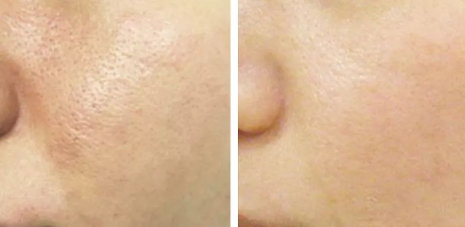 适合黄皮的mm面膜,适合黄皮便宜好用面膜