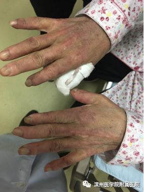 手指发红发白怎么回事,手指突然变色是什么情况