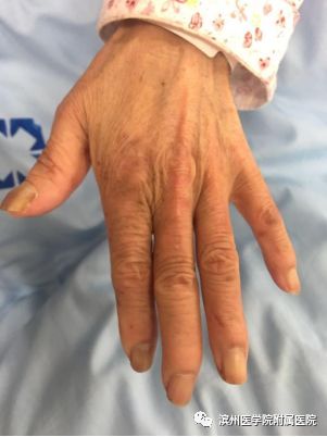 手指发红发白怎么回事,手指突然变色是什么情况