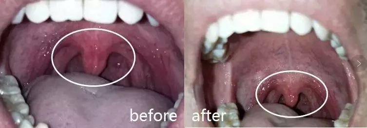 牙龈肿了出血口臭牙黄用什么牙膏,牙龈上火牙膏