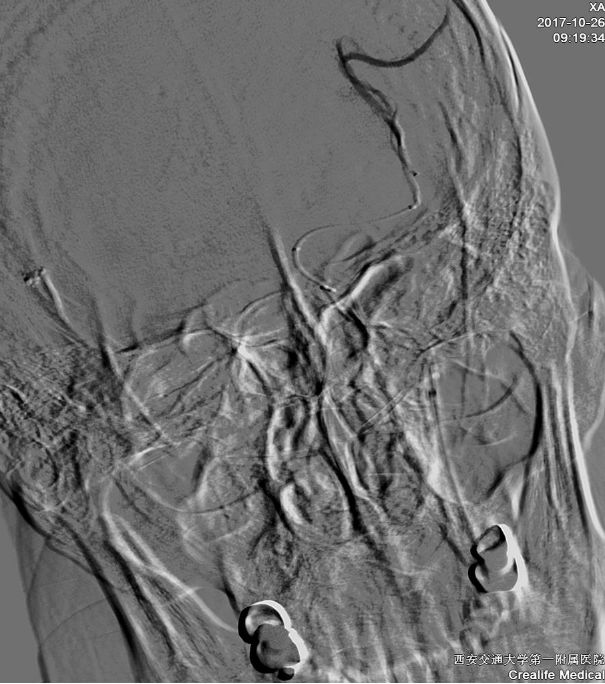 径技·例量|25期：再灌注出血—防不胜防